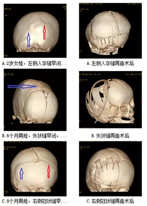 寿星头三角头等宝宝歪头真不是天赋异禀 可能是大麻烦