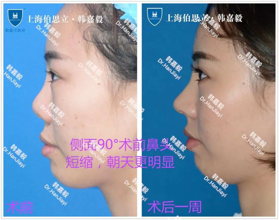 好好的鼻子怎么就变成了朝天鼻