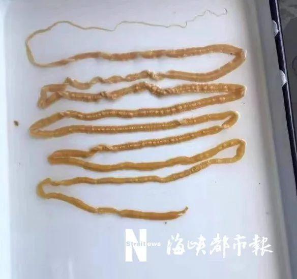 太可怕了!福建男子肚里取出2.9米长绦虫,还是活的