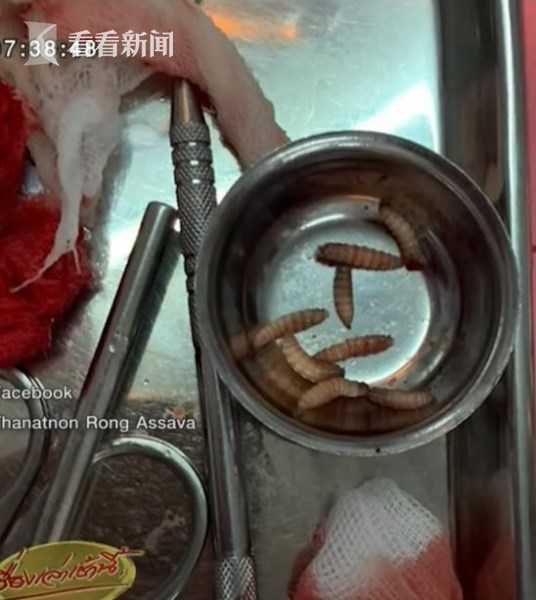 七旬老翁高烧就诊 牙龈破洞竟爬出12条白蛆 医生吓呆这样解释病因