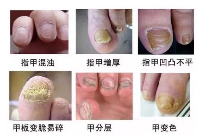 灰指甲,医学上称为甲癣,发生于指(趾)甲及甲下,是一种具有传染性的