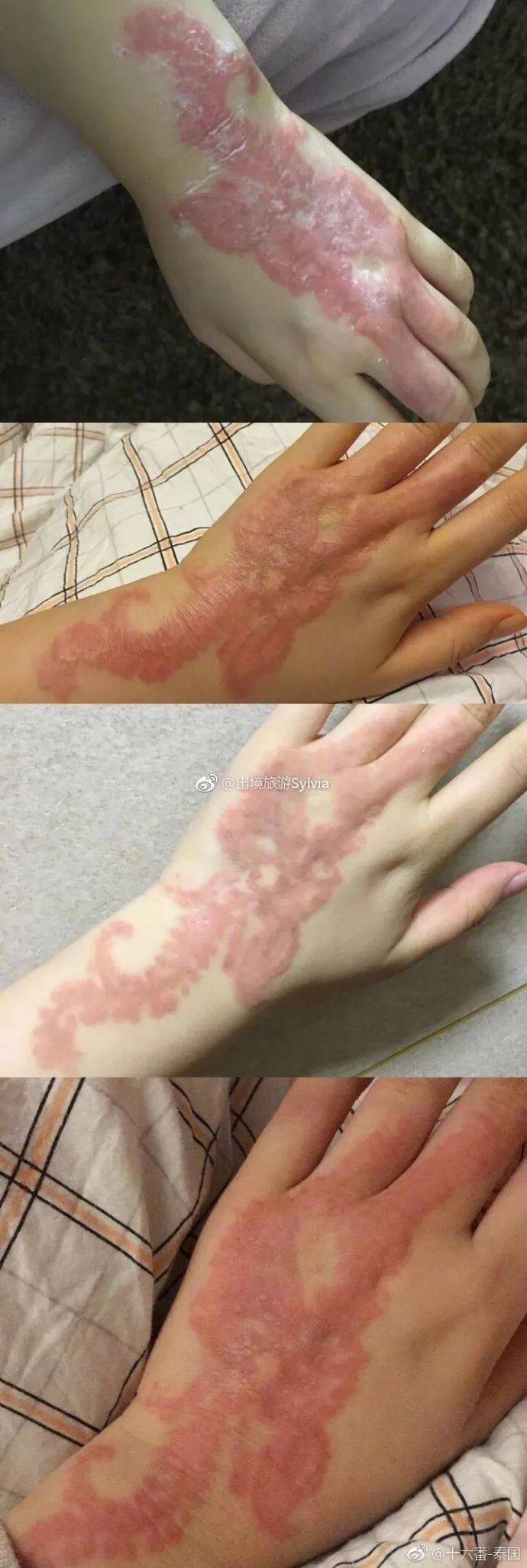 小伙在巴厘岛尝鲜特色服务 没想到现在悔恨终生|过敏|海娜|纹身_新浪