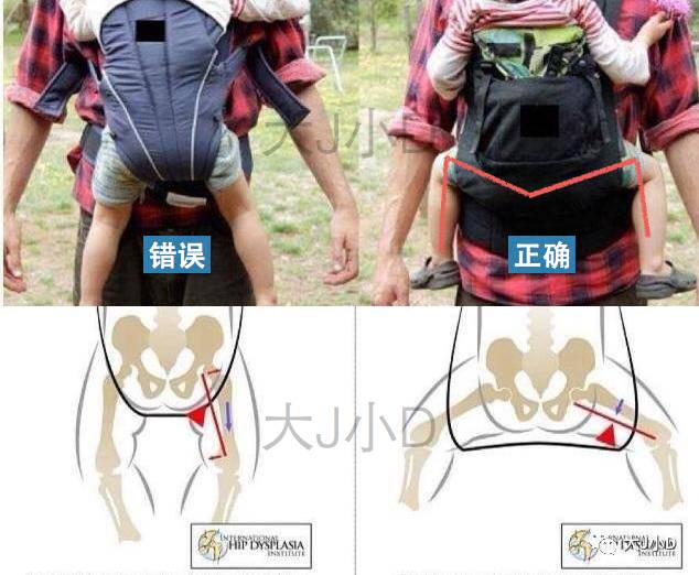 没弄清楚这些之前,千万不要随便使用|宝宝|背带|髋关节_新浪育儿_新浪