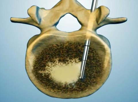 凯利泰单侧骨导向器日本上市