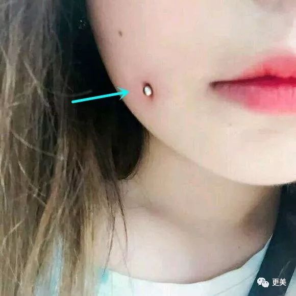 有一个19岁的安徽女孩在某美容机构种植酒窝钉,最后却因为金属钉长在