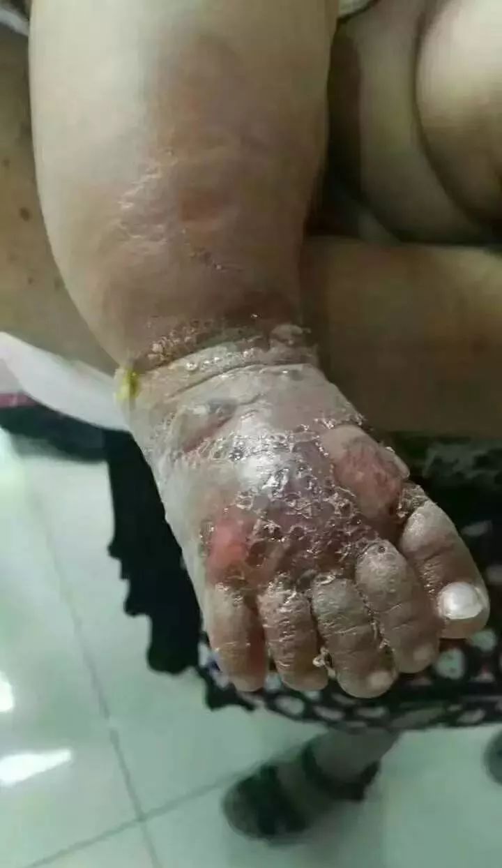 9岁女童被截肢竟因奶奶用花椒治病无知是最难治的病