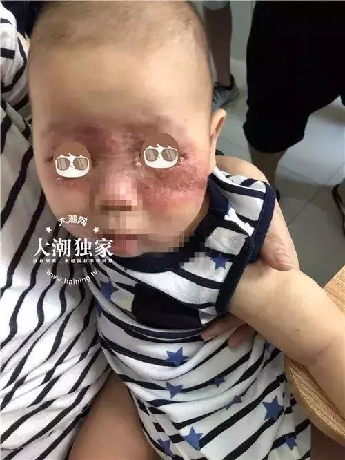 触目惊心一只虫子让十几个月大的孩子几乎毁容