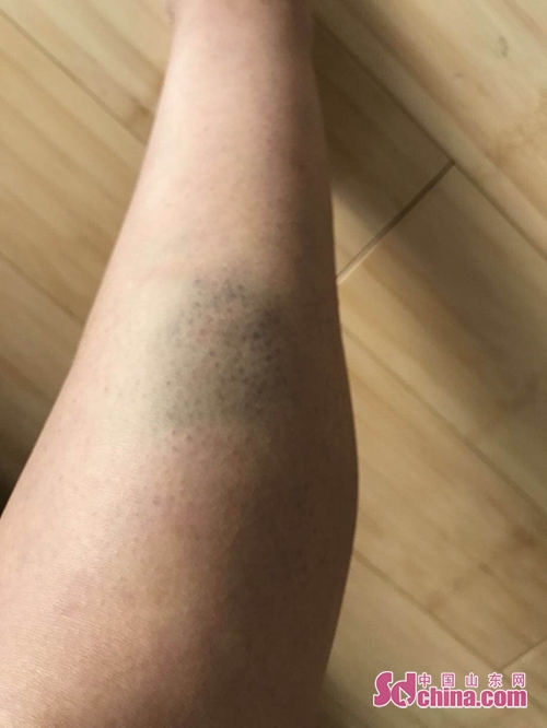 大腿摔紫的图片图片