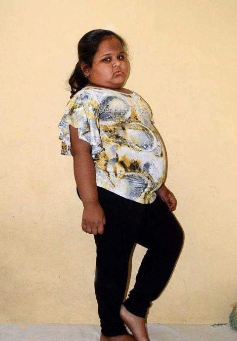 印度8岁小女孩病态肥胖,体重114斤, 一天吃掉3斤米饭