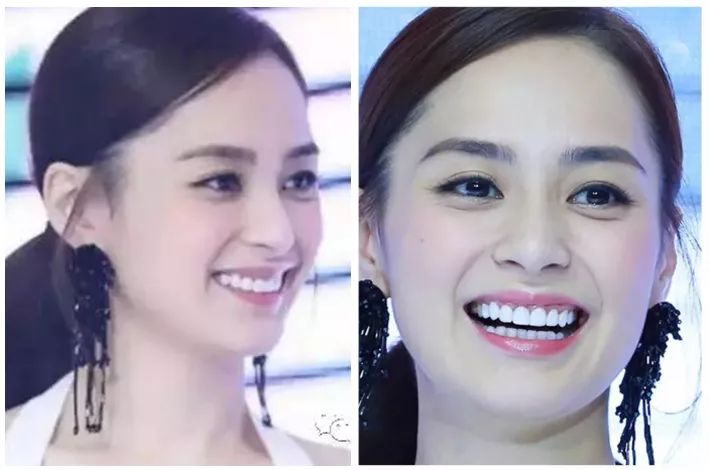 娜扎的烤瓷牙看着比唐艺昕,阿娇的高级一点唉