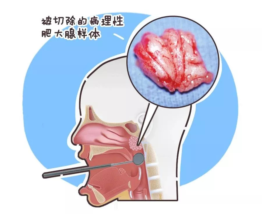 孩子睡觉时的这个习惯,会让他越长越丑|腺样体|打鼾|宝宝_新浪育儿
