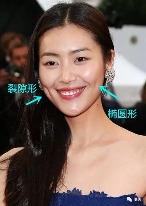 酒窝成形术|切口|少女_新浪女性_新浪网