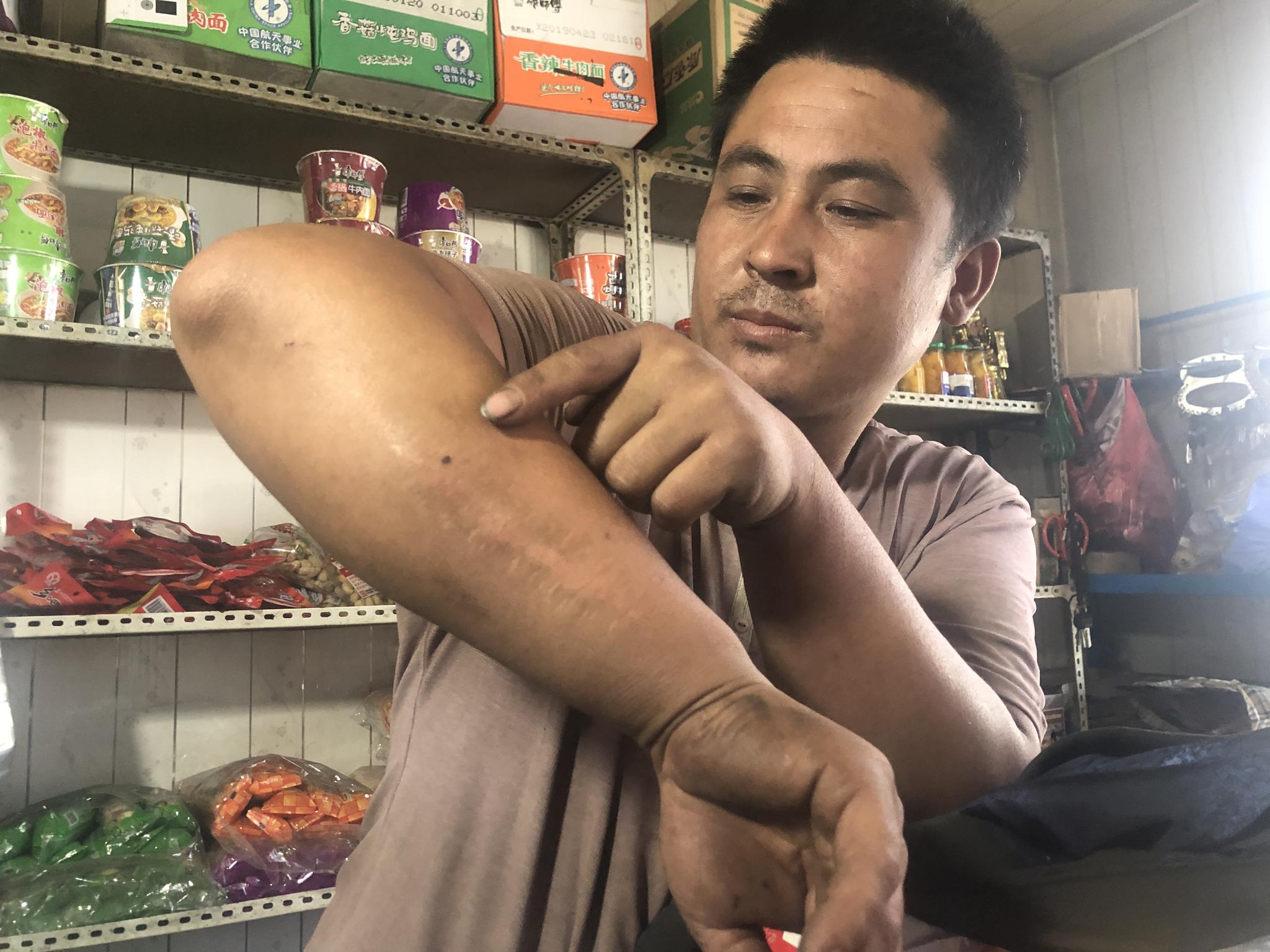 煤老板涉黑落网 所涉“砍刀队”造成多起恶性案件 范廷才二弟范廷有向记者展示其被打的伤疤。新京报记者 卢通 摄