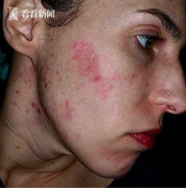 女子公厕用皂液洗手脸部竟腐烂现坑洞
