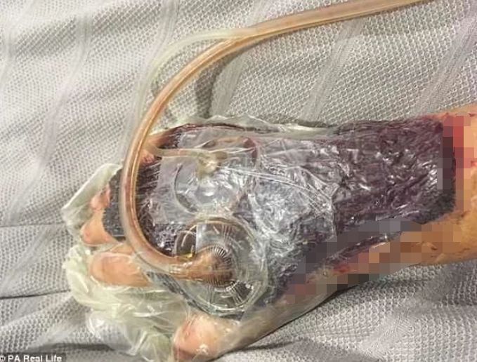 搬家割破手后女子没在意,之后发生的事却让她痛苦不堪……|搬家|手术
