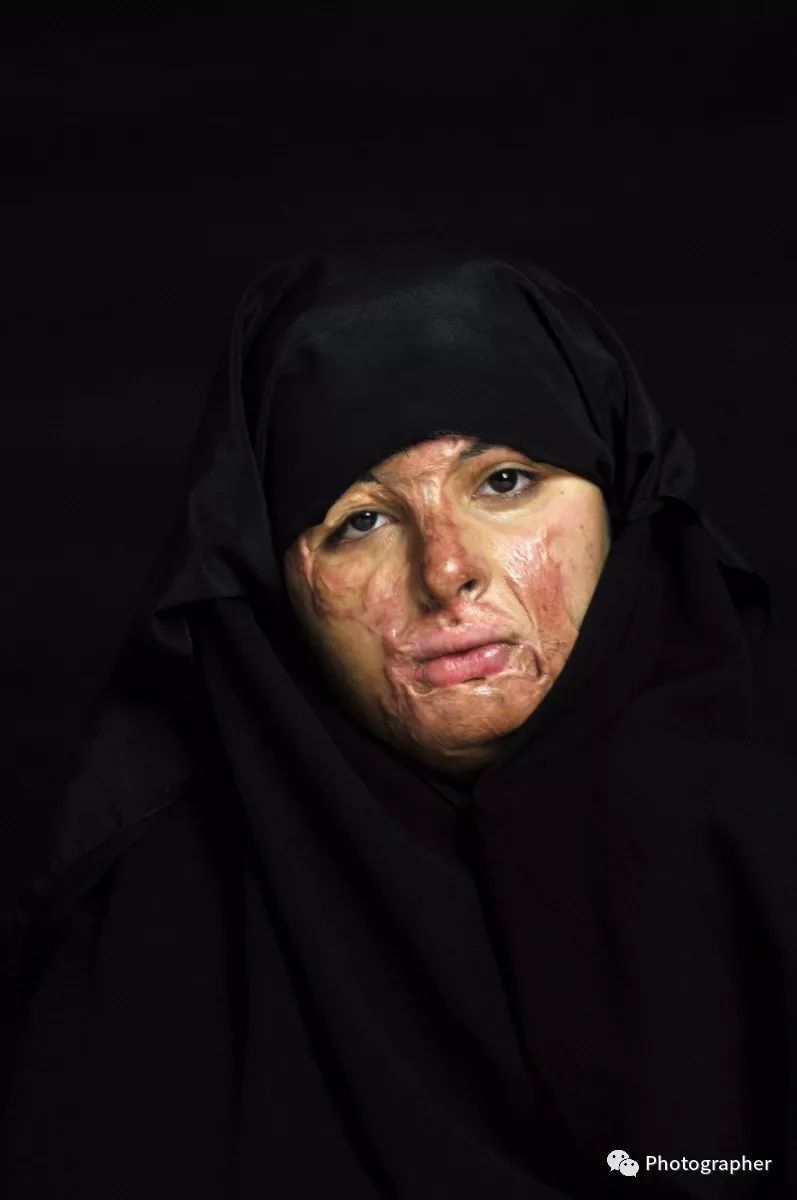 2009年,当她在购买冰淇淋时,遭遇炸弹爆炸,她的脸,胸部,手臂和什靠