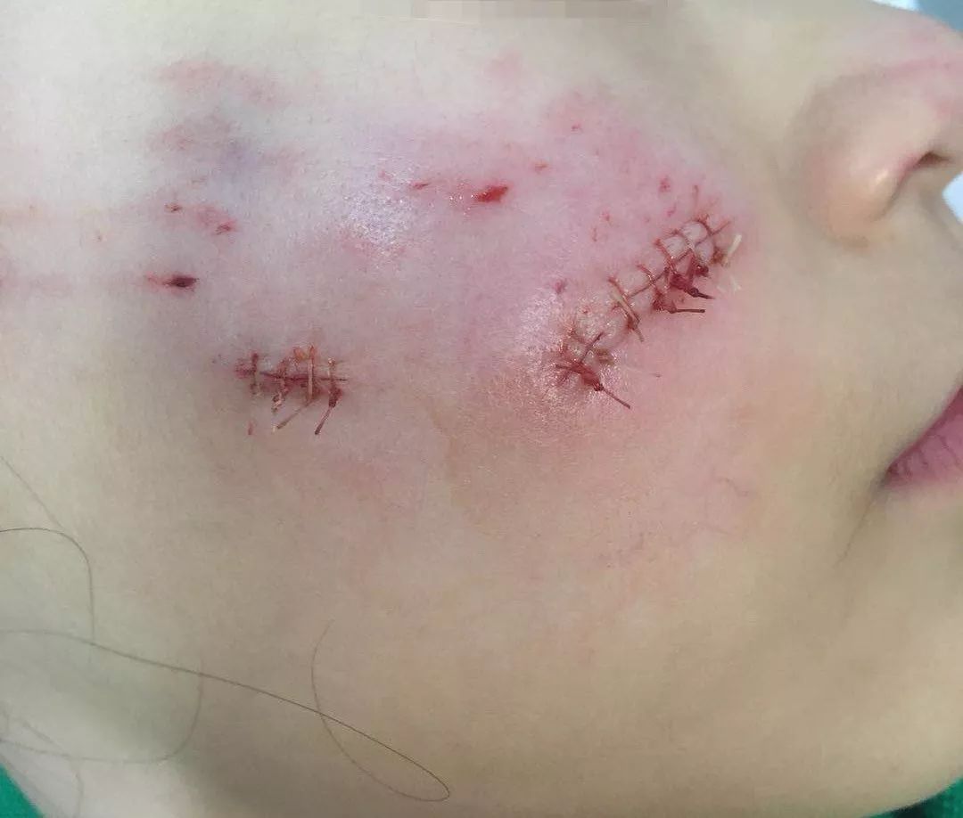 家长只顾打麻将,哈尔滨6岁孩子破相. | 不止一例!