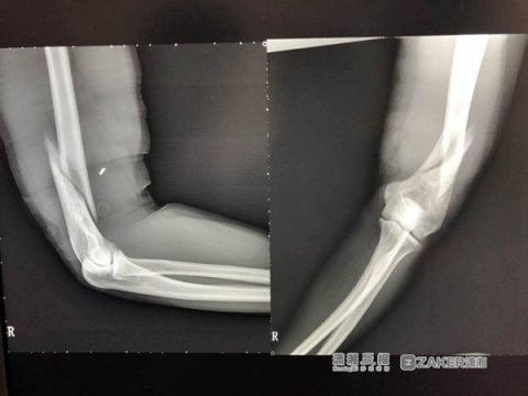 长沙小伙掰手腕用力过猛,手臂竟然骨折了
