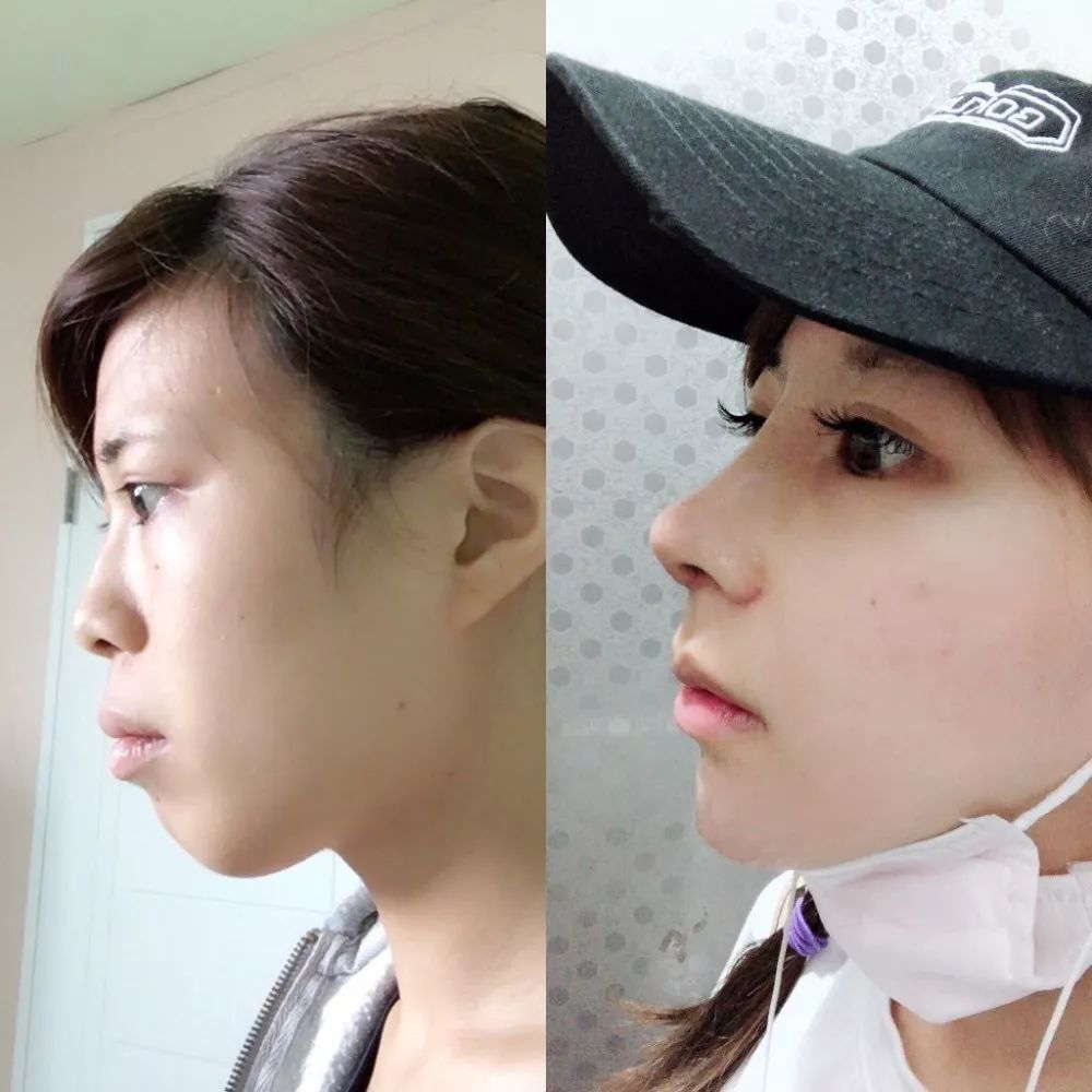 日本妹子花700万整成小仙女,不仅自曝整容细节,还大方po出整容前后