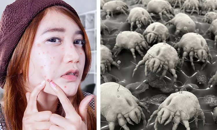 每晚,100万虫子在你脸上钻洞