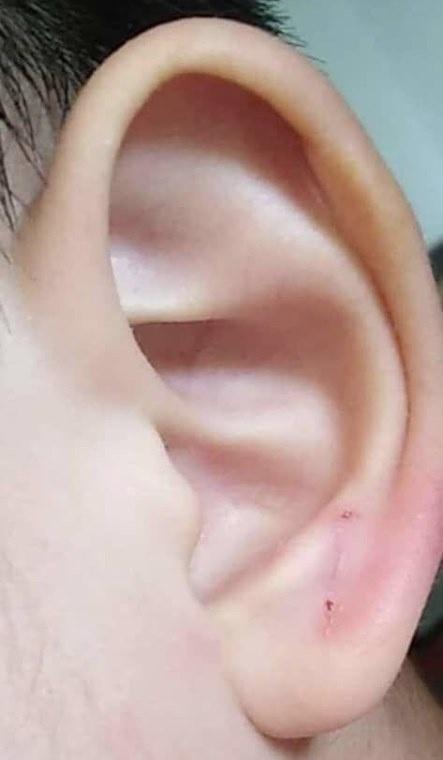 大马4岁男童疑遭幼儿园老师虐待耳朵现2深孔疑被订书机打穿