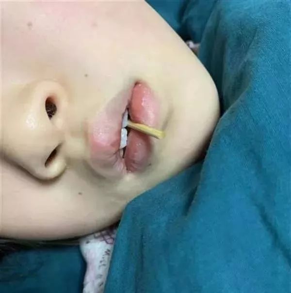 竹签扎入喉咙刺穿脑干10岁女童玩蹦床时突然摔倒当时她嘴里正咬着一个
