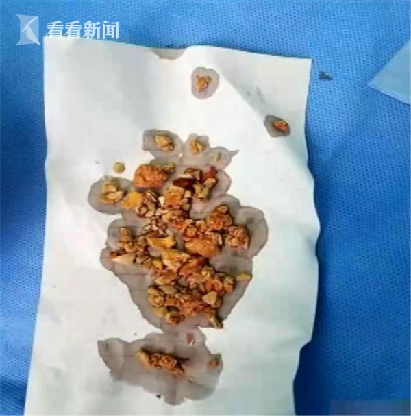 5个月大婴儿双肾长满结石 全身浮肿险丧命