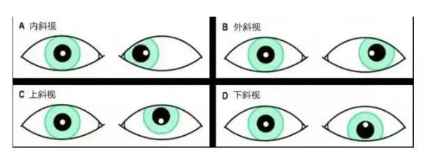 1岁男童玩手机成斗鸡眼这个眼病成人小孩都要当心