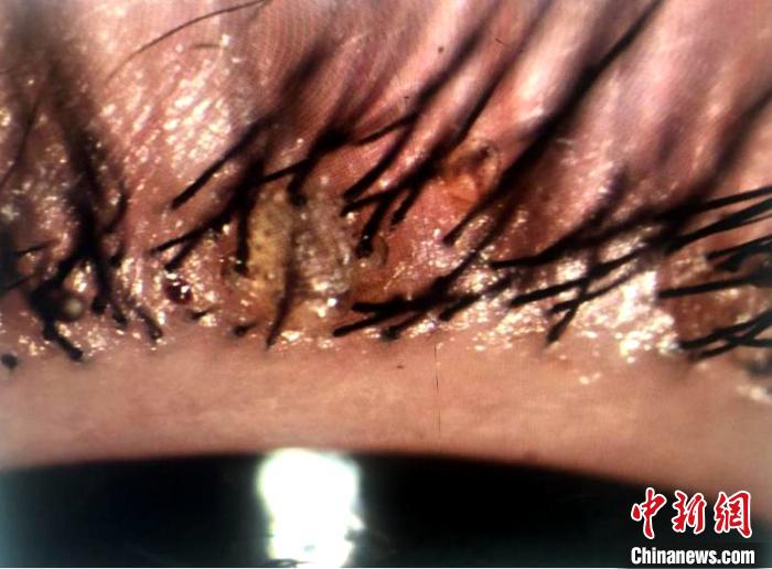 2岁女孩眼睛长满虱子 医生提醒预防需讲究个人卫生