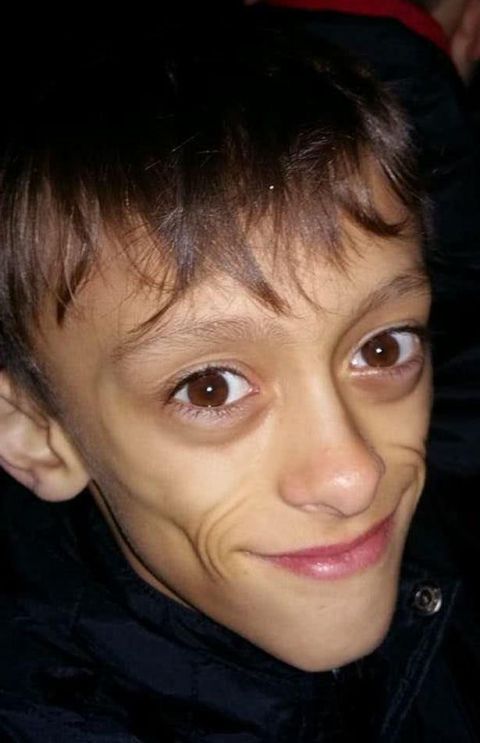 英国男孩患怪病吃再多也不胖 眼大脸尖被称"外星人"