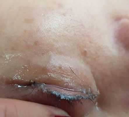 女子赴美容院接睫毛 惨遭用「强力胶水黏」 眼睛肿成面包大