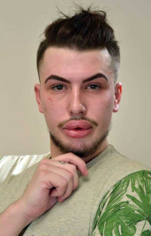 16岁小伙每年花数十万元丰唇 24岁成了这样!