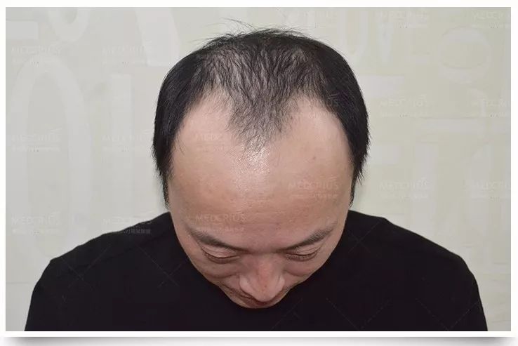 真的假的秃顶5年竟在1天内长出真发背后原因无奈又心酸