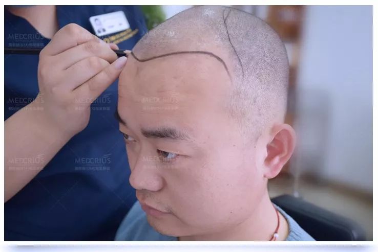 头发也可以种出来?遗传性脱发、秃顶、前额光