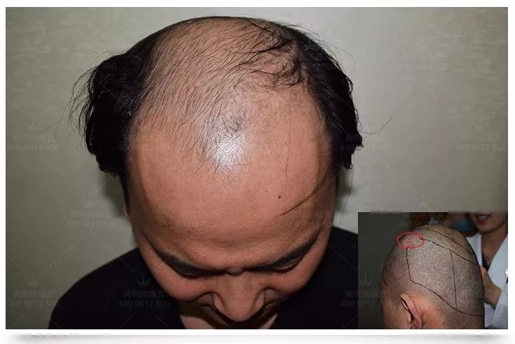 每天掉多少根头发算正常?超过了是病理性脱发!