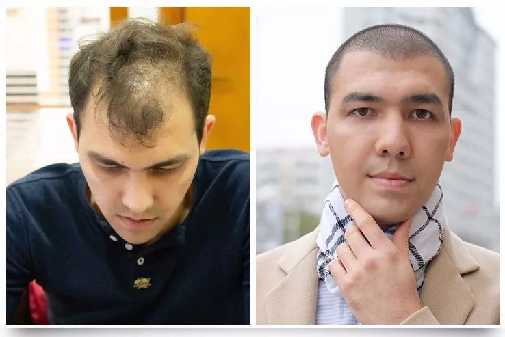 黑龙江秃顶大叔只有31岁,一个选择让他重回"颜值巅峰"!