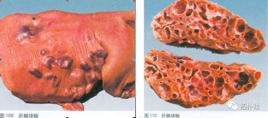 科普一下,肝包虫病是个非常可怕的寄生虫病.