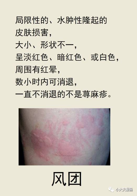 "风疙瘩" 荨麻疹