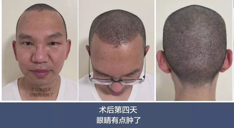 植发医生自己的植发经历分享下