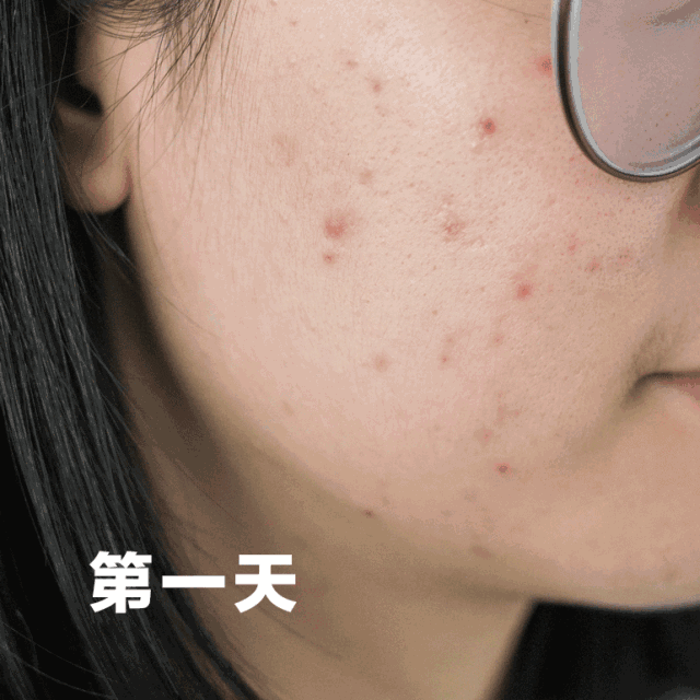 痘痘痘印烂脸怎么办这个8000人疯传的绝招我替你们试过了