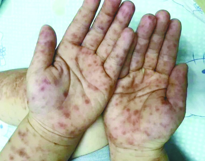 本月岛城手足口病出现小高峰今年手足口病特征可表现为大疱样皮疹
