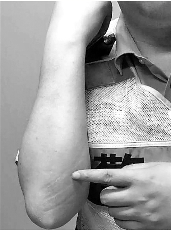 幸好右胳膊挡刀的时候,碰到的是刀背,他小臂上也留下了一大道红印.