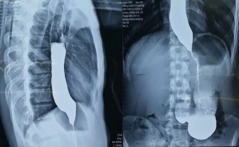手术前钡餐提示食管下段鸟嘴样改变,钡剂通过受阻