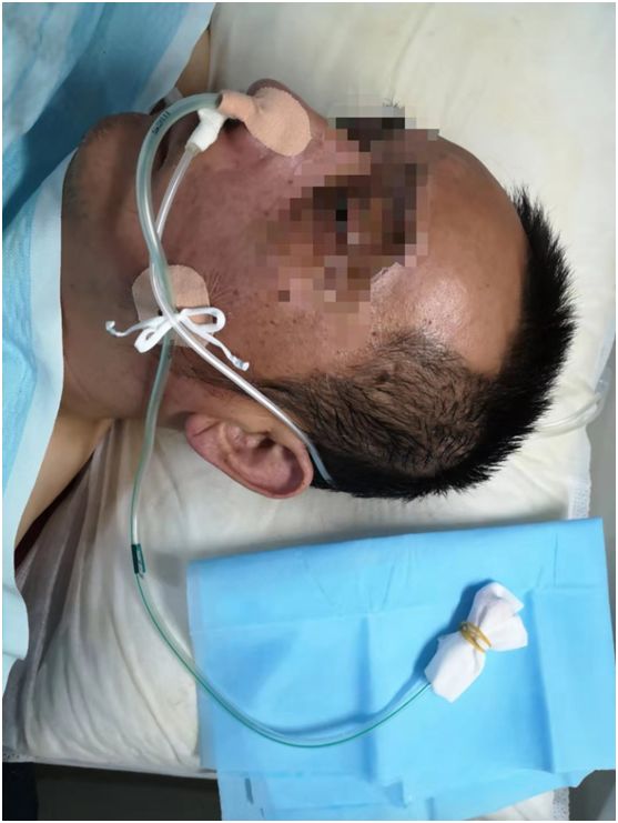 鼻胃管固定不牢麻烦多?教你一种改良固定法~|3M|胃管|胶布_新浪新闻
