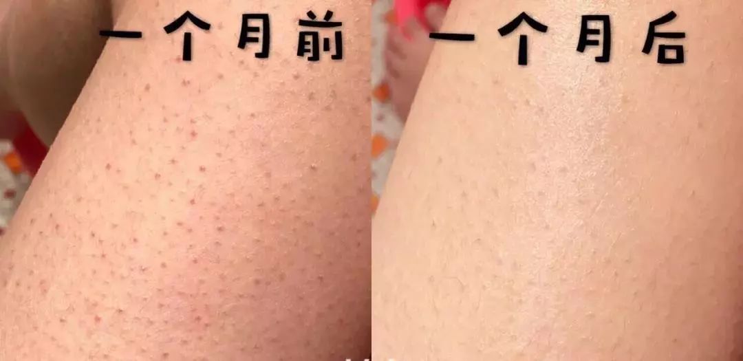 怎么突然变成鸡皮肤了(怎么突然变成鸡皮肤了呢) 怎么突然变成鸡皮肤了(怎么突然变成鸡皮肤了呢)