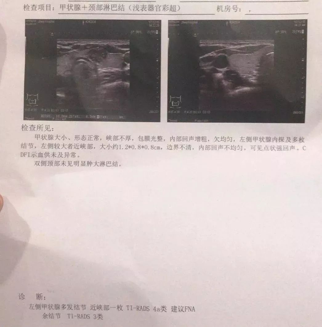 12月15日,医院的甲状腺b超报告出来了,医生说"很严重了!
