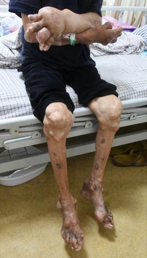 每天喝酒半斤以上,大叔全身关节长满石头变身"树人"