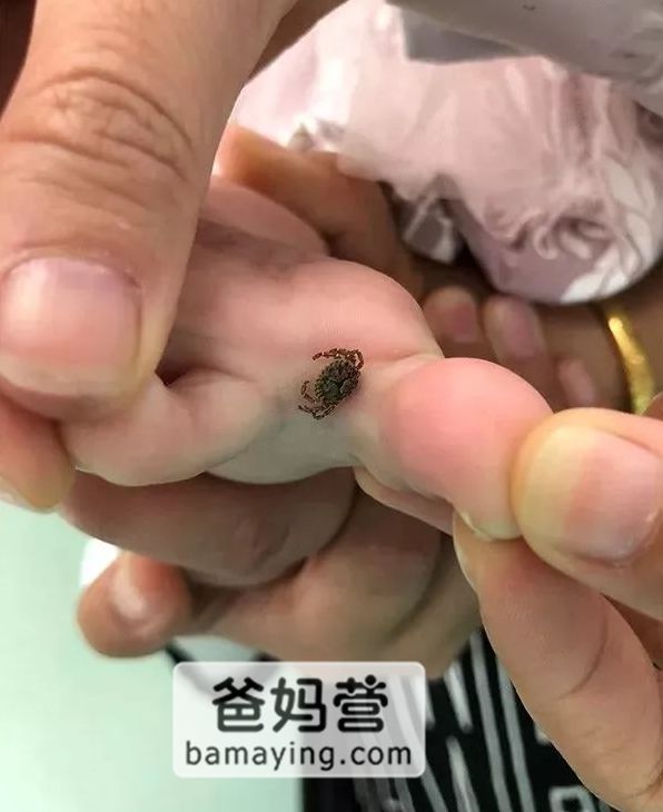 下面的图就是孩子脚趾间的蜱虫,虫子头部已经钻进去.