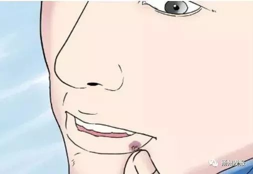 女子熬夜追剧,变成"香肠嘴"!这病可能会传染,最近高发