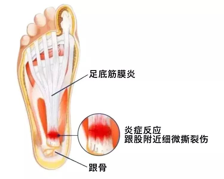 下面8种疼痛信号出现时 你可能已经把自己跑伤了 手机新浪网 下面8种疼痛信号出现时 你可能已经把自己跑伤了 手机新浪网